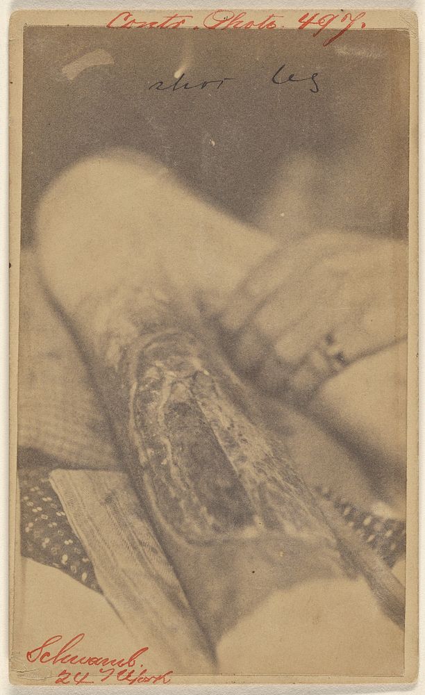 Wounded leg of R. Schwamb, Civil War victim by Edward J Ward