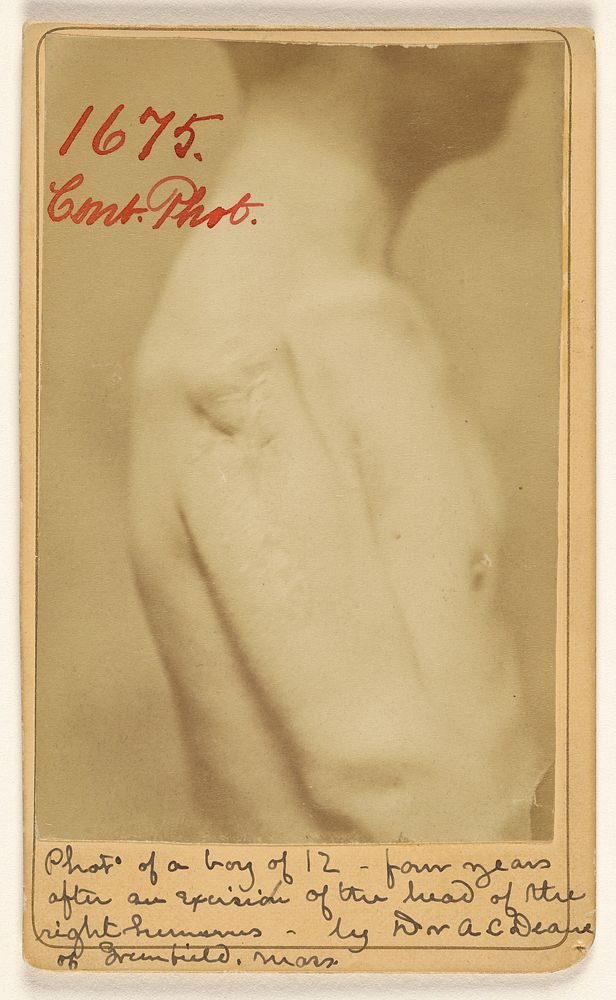 Photo of a boy of 12 - four years after an Excision of the head of the right humerus. by Dr. A.C. Deane of Springfield…
