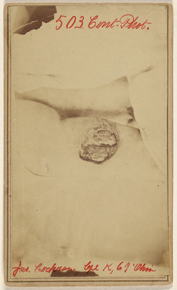 Thigh wound of James Cochran, Civil War victim