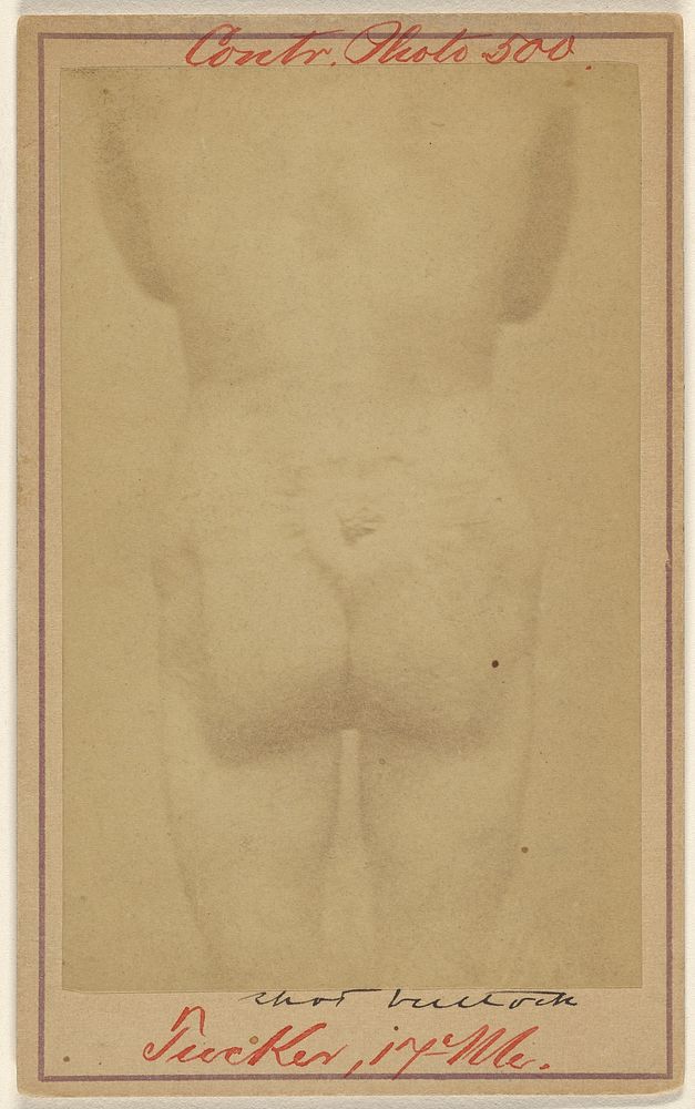 Jno. E. Tucker, shot in the buttocks, Civil War victim