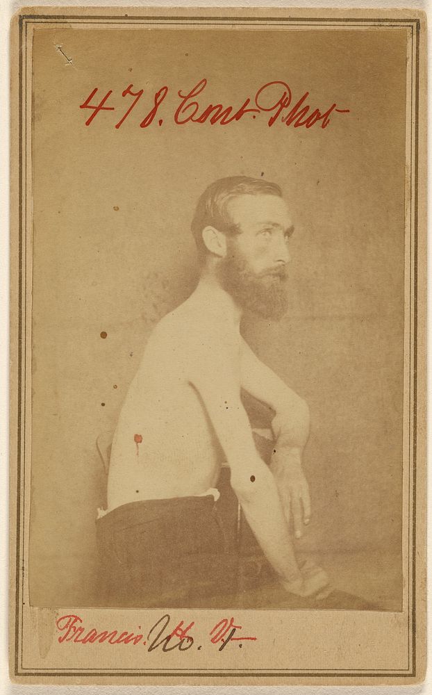 Francis. H.V. -, Civil War Victim by W E Whitehead