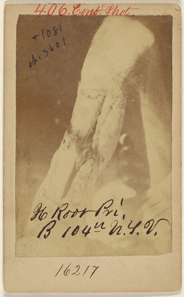 Wound of H. Root, Civil War victim by Reed Brockway Bontecau
