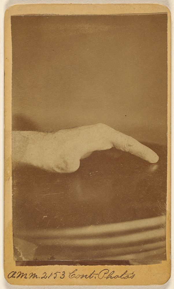 Right hand of Saml. Hagle, wounded at Petersburg (---illeg.) June 17th 1864. by H D Ward