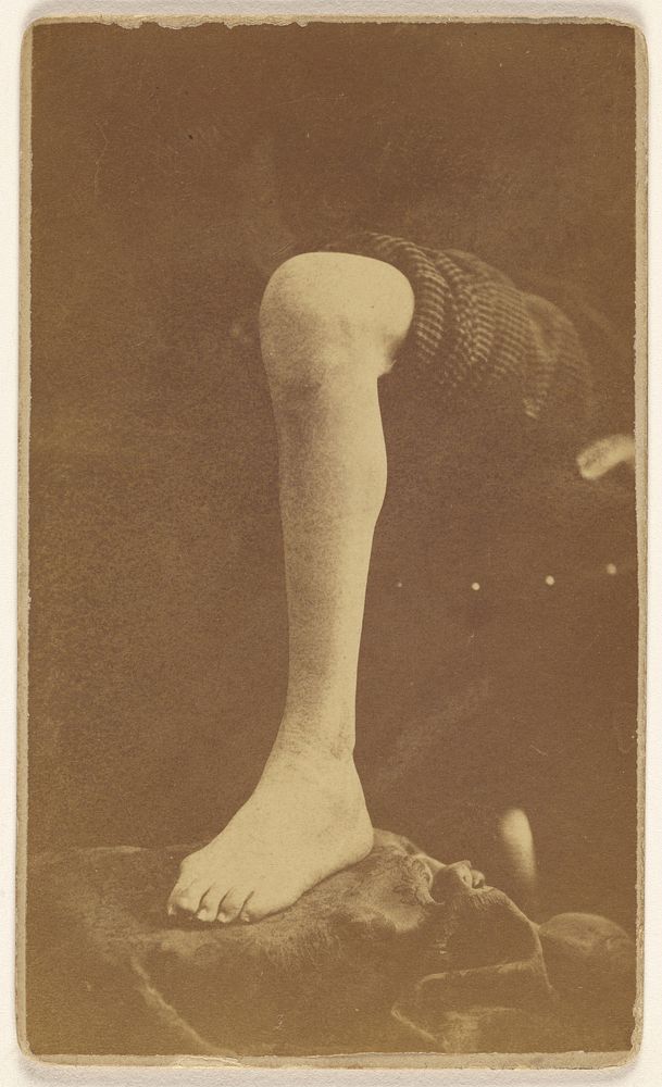 Excision ankle joint Pt. Robert Fuller 45th Ill. Post office Bedford Ohio [Civil War victim] by J Dennison