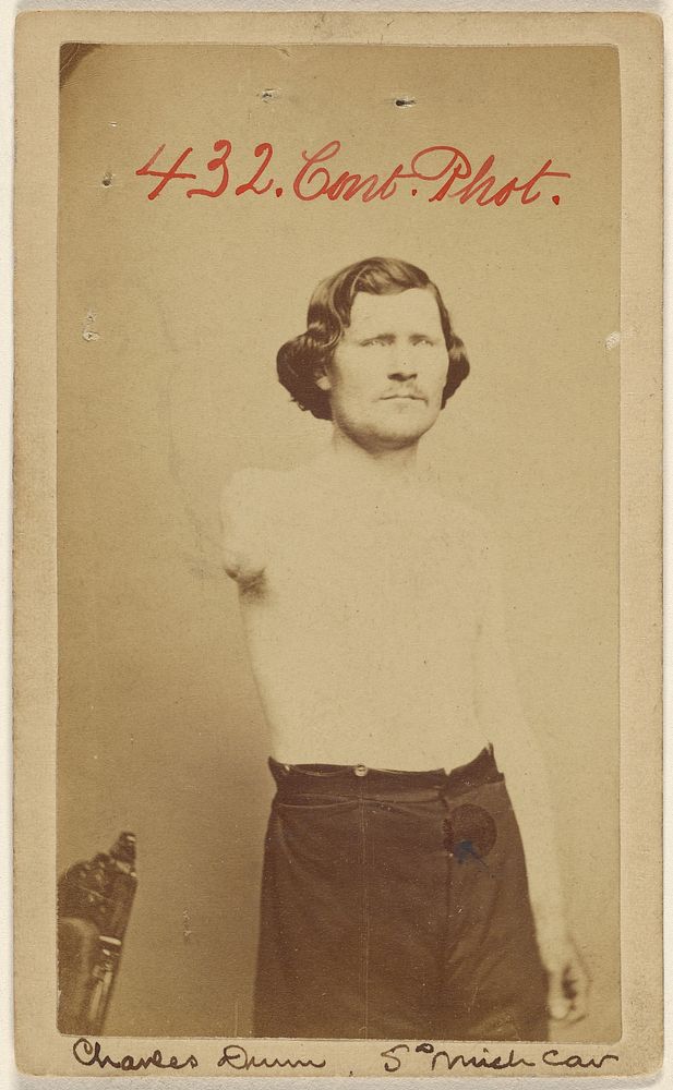 Charles Dunn 5th Mich. Cav. [Civil War victim lacking an arm]