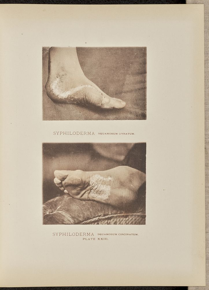 Syphiloderma squamosum circinatum and syphiloderma squamosum gyratum by Dr George Henry Fox