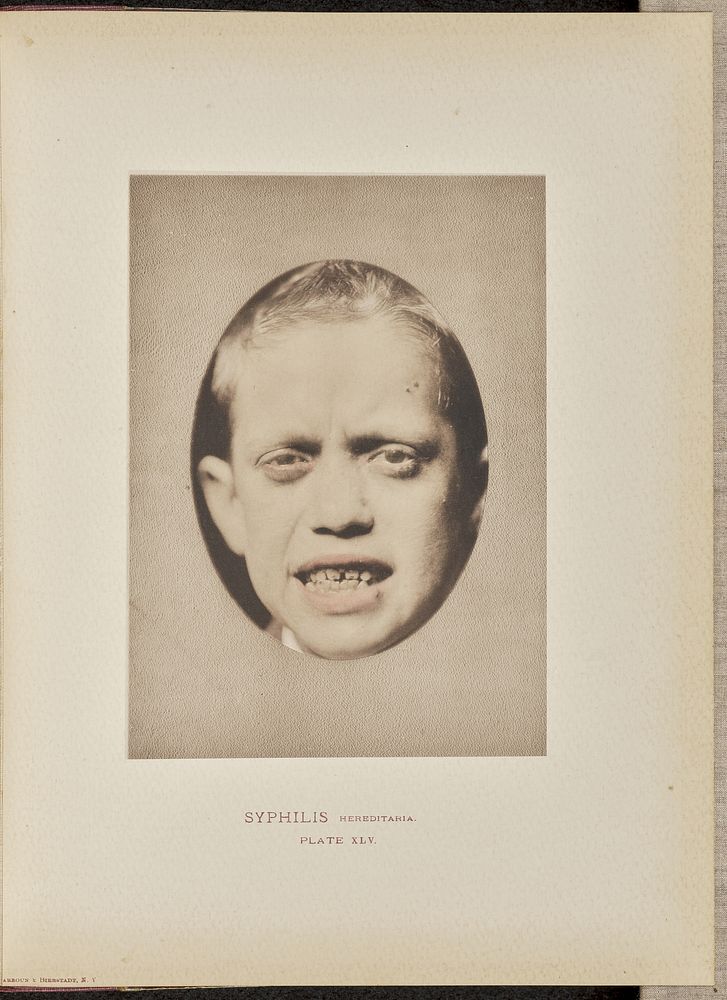 Syphilis hereditaria by Dr George Henry Fox