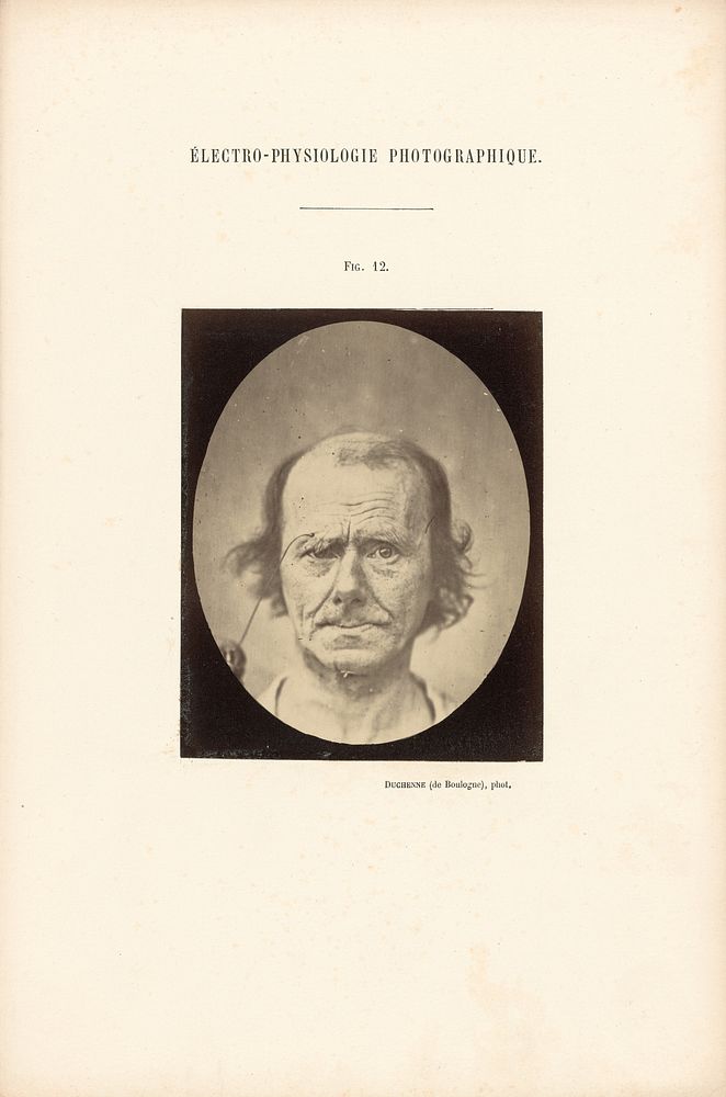 Électro-Physiologie Photographique, Figure 12 by Guillaume Benjamin Duchenne and Adrien Alban Tournachon