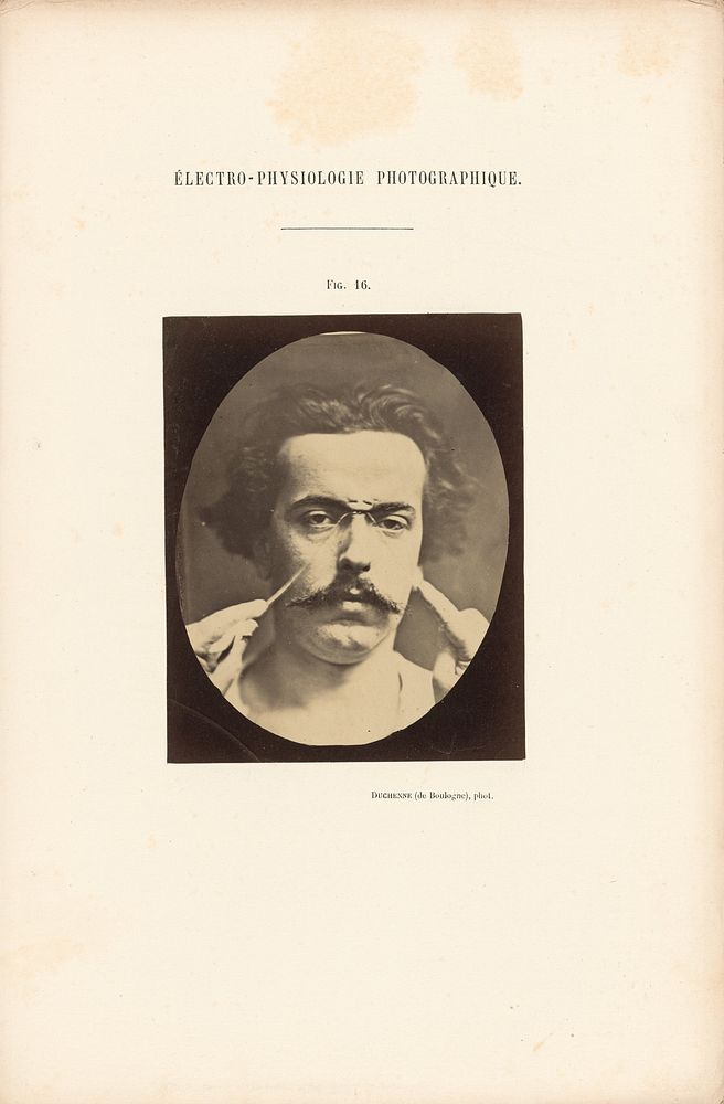 Électro-Physiologie Photographique, Figure 16 by Guillaume Benjamin Duchenne and Adrien Alban Tournachon