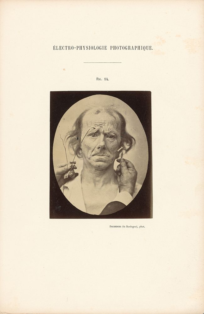 Électro-Physiologie Photographique, Figure 14 by Guillaume Benjamin Duchenne and Adrien Alban Tournachon