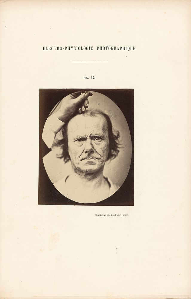 Électro-Physiologie Photographique, Figure 17 by Guillaume Benjamin Duchenne and Adrien Alban Tournachon