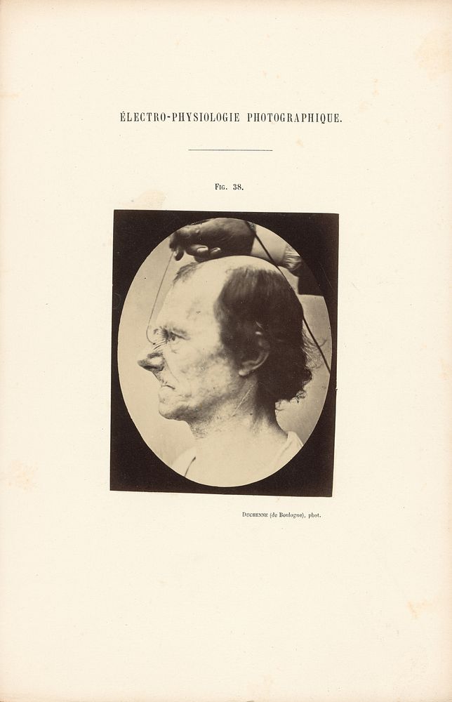 Électro-Physiologie Photographique, Figure 38 by Guillaume Benjamin Duchenne and Adrien Alban Tournachon