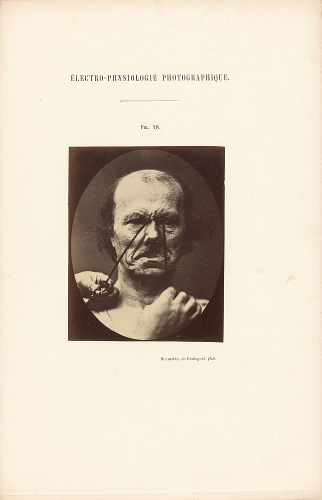 Électro-Physiologie Photographique, Figure 18 by Guillaume Benjamin Duchenne and Adrien Alban Tournachon