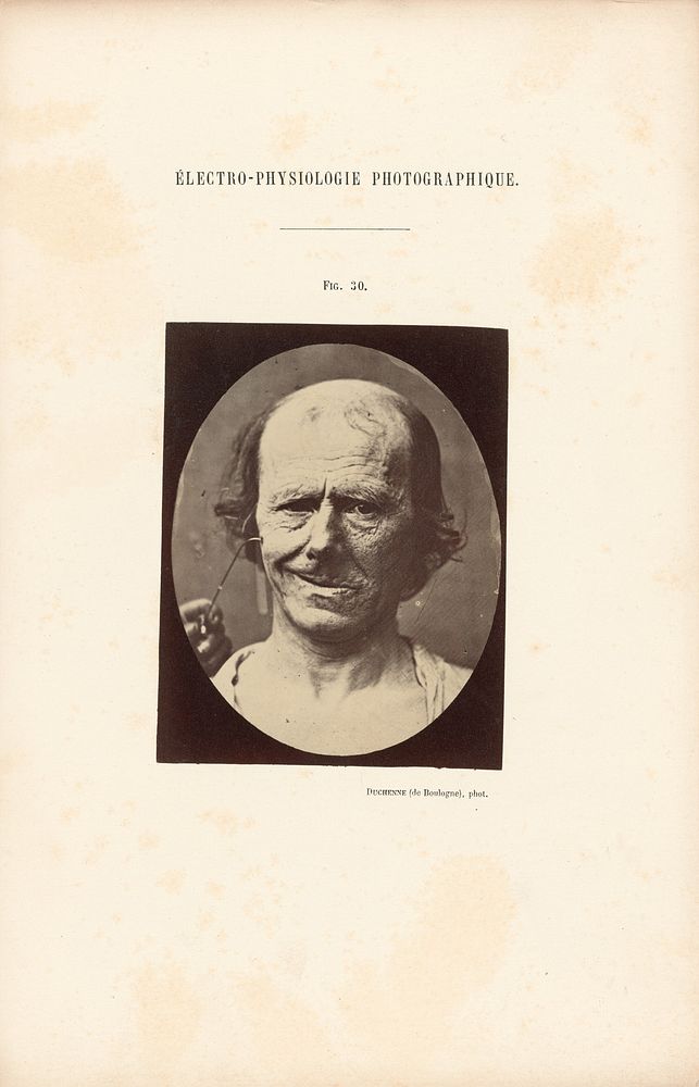 Électro-Physiologie Photographique, Figure 30 by Guillaume Benjamin Duchenne and Adrien Alban Tournachon