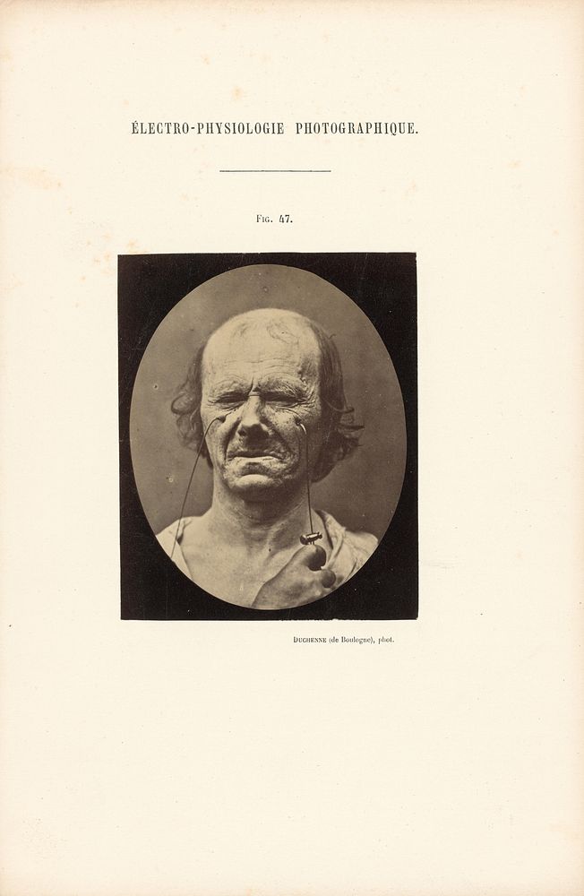 Électro-Physiologie Photographique, Figure 47 by Guillaume Benjamin Duchenne and Adrien Alban Tournachon
