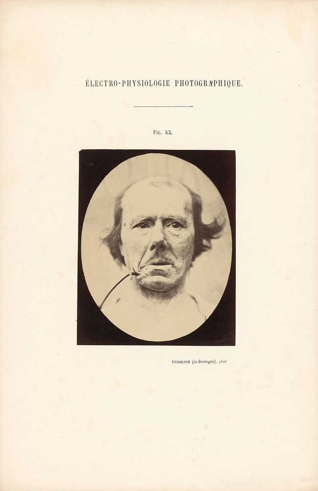 Électro-Physiologie Photographique, Figure 43 by Guillaume Benjamin Duchenne and Adrien Alban Tournachon