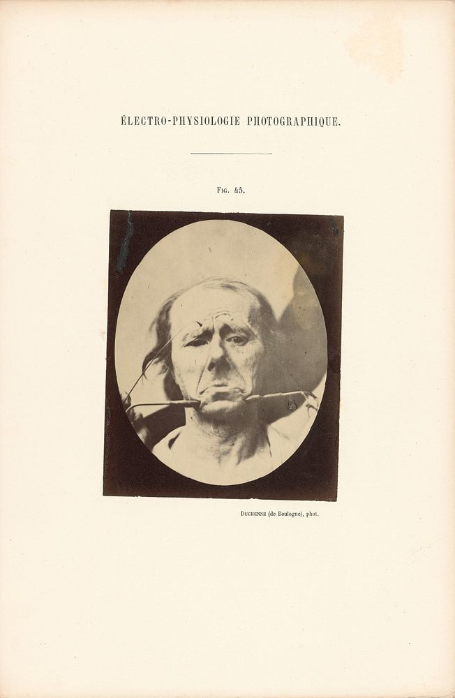 Électro-Physiologie Photographique, Figure 45 by Guillaume Benjamin Duchenne and Adrien Alban Tournachon