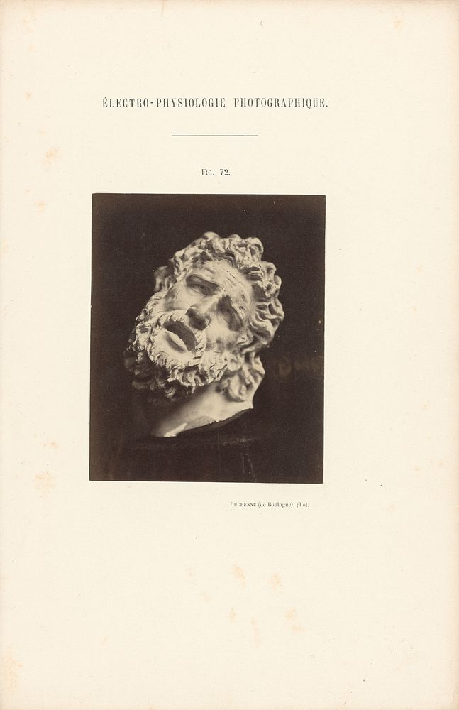 Électro-Physiologie Photographique, Figure 72 by Guillaume Benjamin Duchenne and Adrien Alban Tournachon