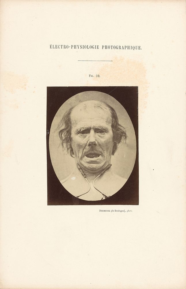 Électro-Physiologie Photographique, Figure 59 by Guillaume Benjamin Duchenne and Adrien Alban Tournachon