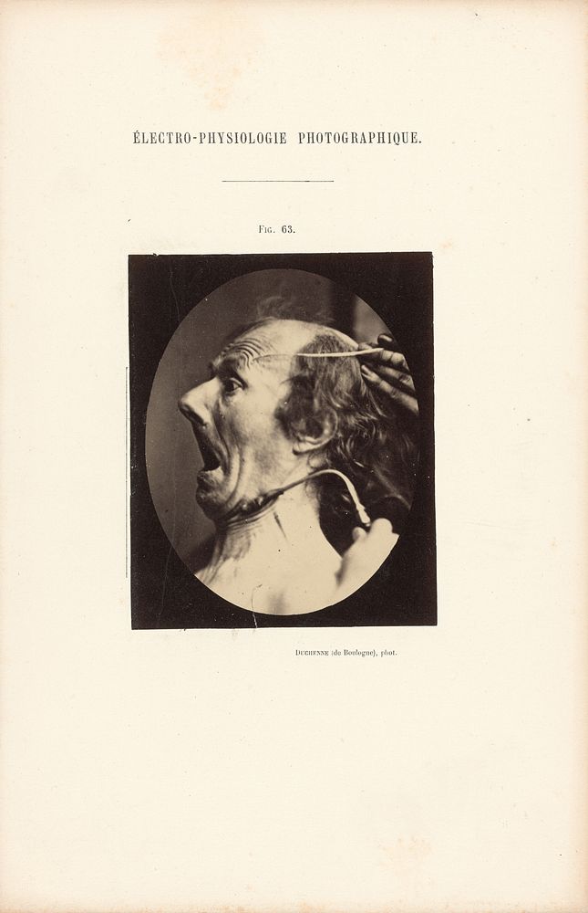 Électro-Physiologie Photographique, Figure 63 by Guillaume Benjamin Duchenne and Adrien Alban Tournachon