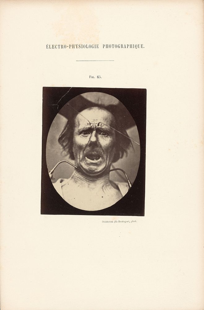 Électro-Physiologie Photographique, Figure 65 by Guillaume Benjamin Duchenne and Adrien Alban Tournachon
