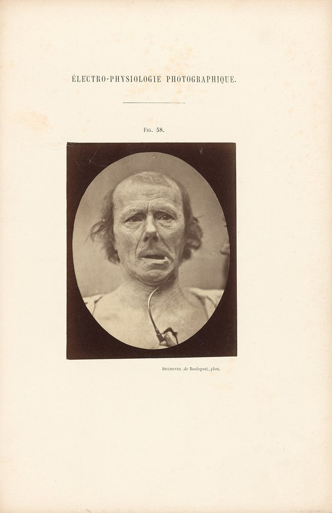 Électro-Physiologie Photographique, Figure 58 by Guillaume Benjamin Duchenne and Adrien Alban Tournachon