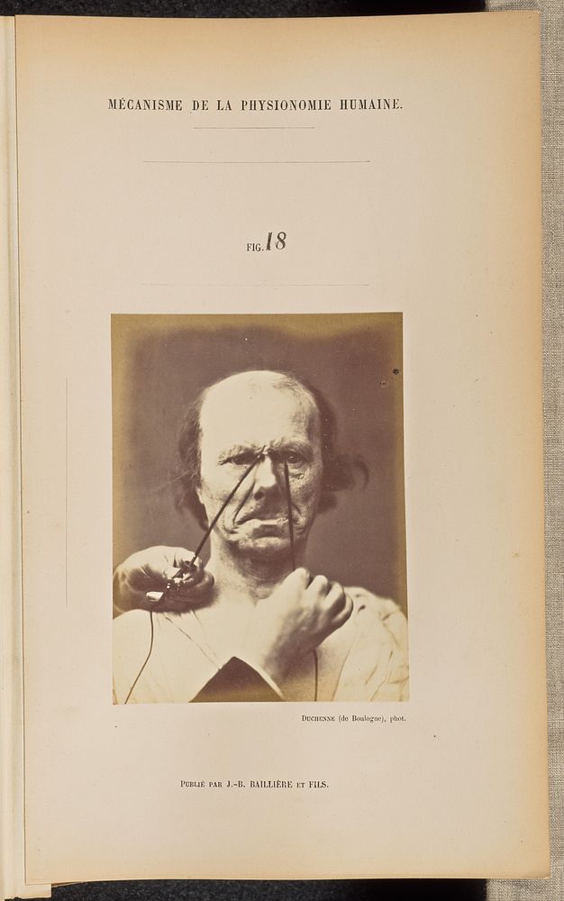 Fig. 18 by Guillaume Benjamin Duchenne and Adrien Alban Tournachon