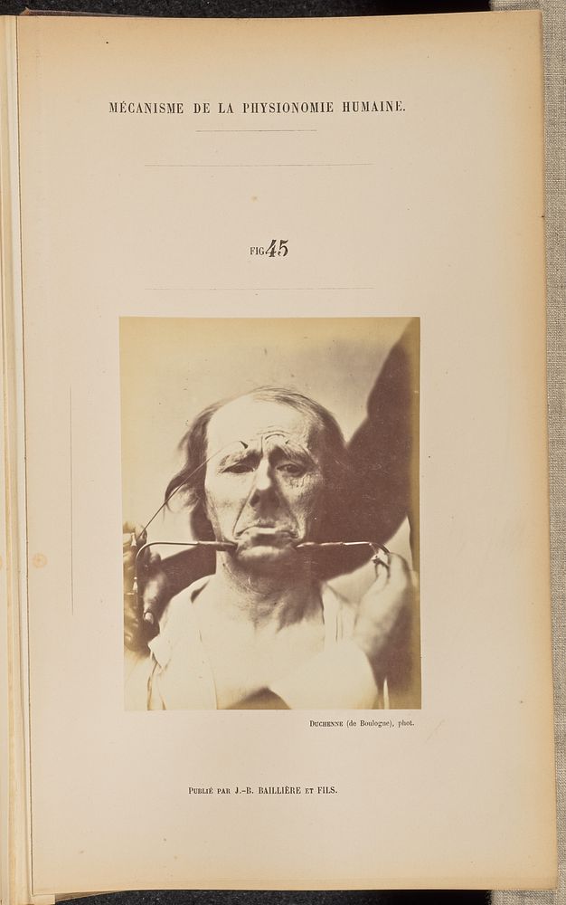 Fig. 45 by Guillaume Benjamin Duchenne and Adrien Alban Tournachon