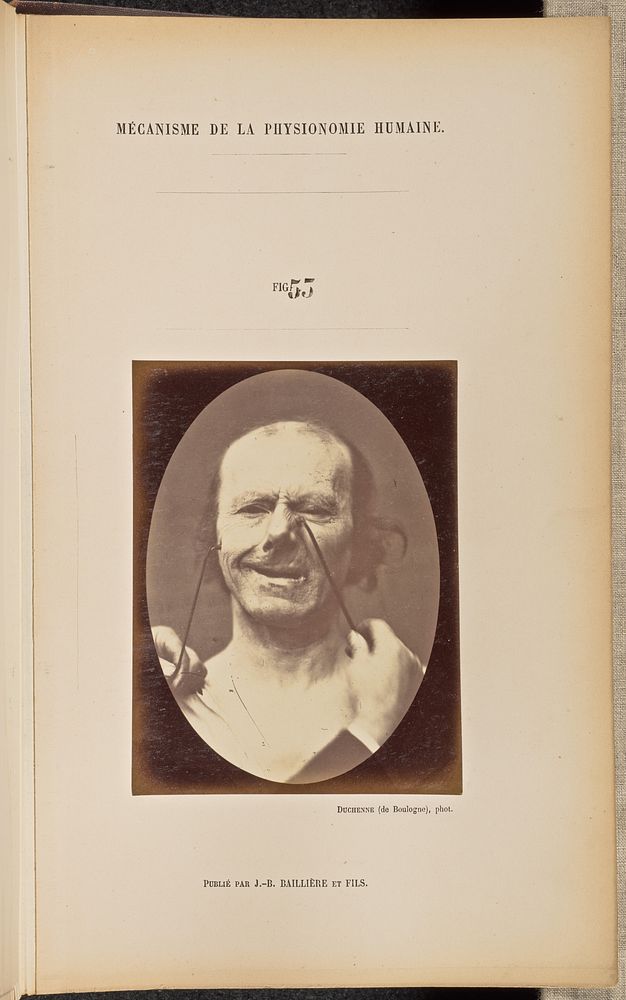 Fig. 53 by Guillaume Benjamin Duchenne and Adrien Alban Tournachon