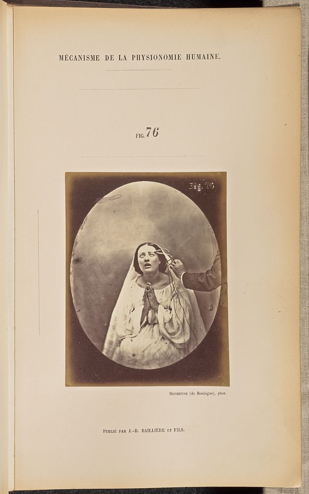 Fig. 76 by Guillaume Benjamin Duchenne and Adrien Alban Tournachon