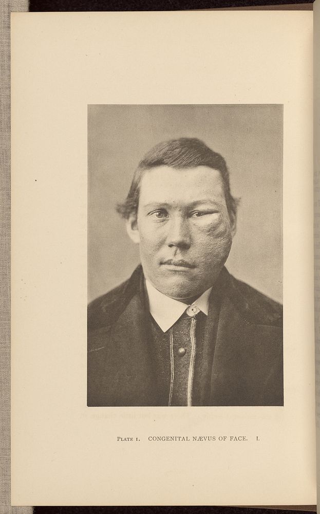 Congenital Nævus of Face by Charles B Brigham