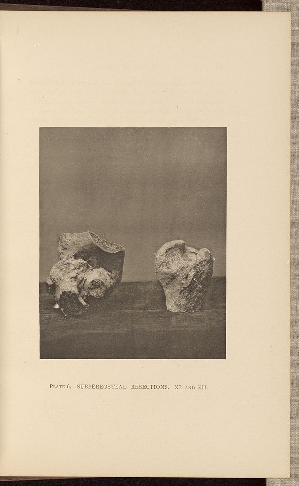 Subpereosteal Resections by Charles B Brigham
