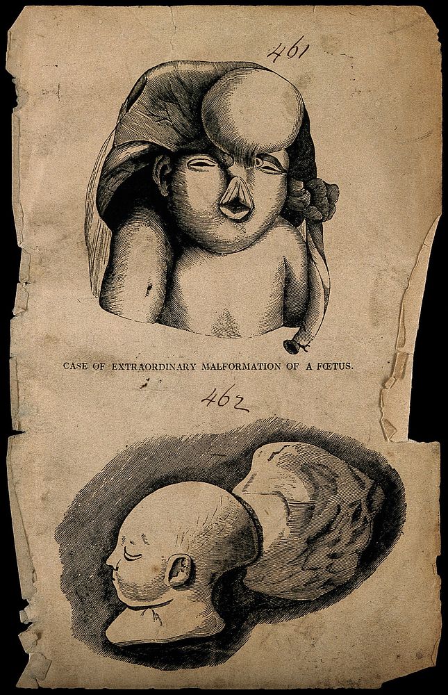 A malformed foetus. Wood engraving.