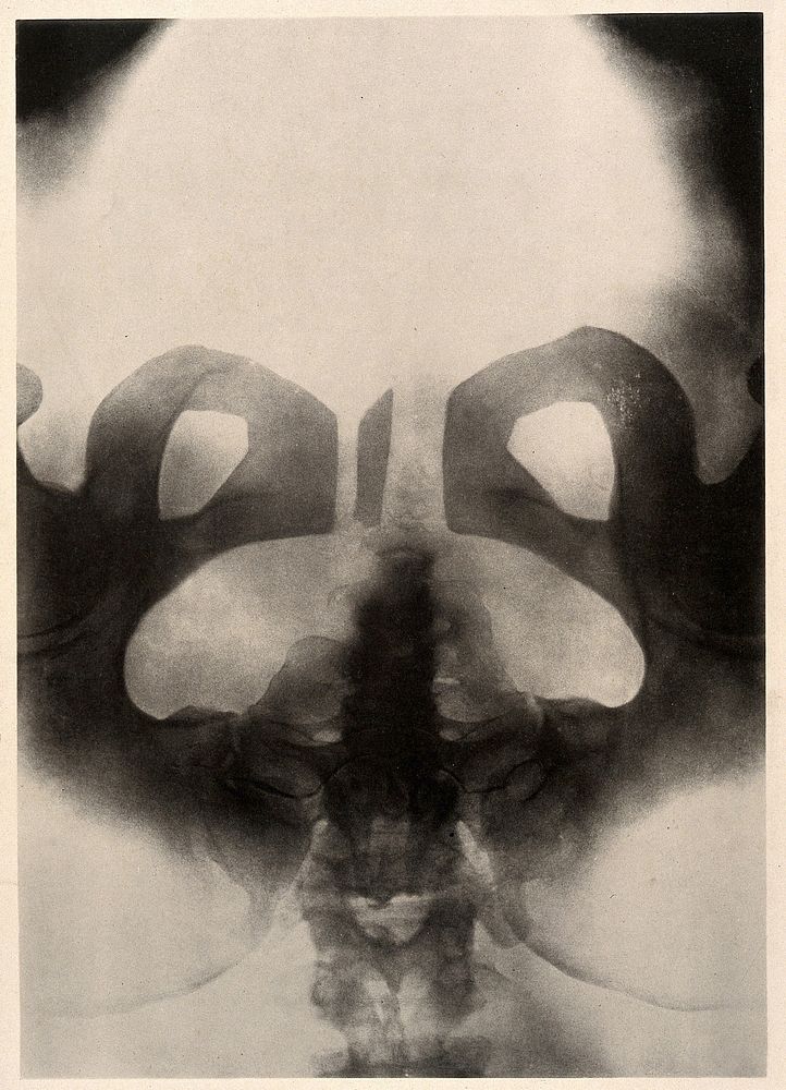 A woman's pelvis after a pubiotomy - to widen the birth canal for a vaginal delivery of a baby. Collotype by Römmler & Jonas…