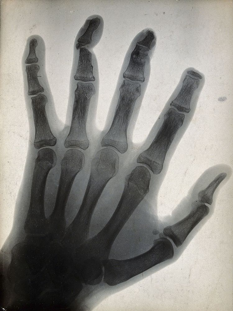 The bones of a hand, with the tip of the index finger missing, viewed through x-ray. Photoprint from radiograph after Sir…