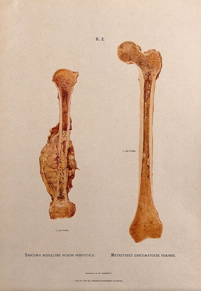 Sections through humerus and femur bones, two figures: the left illustration indicating a sarcoma (bone tumour) on the…