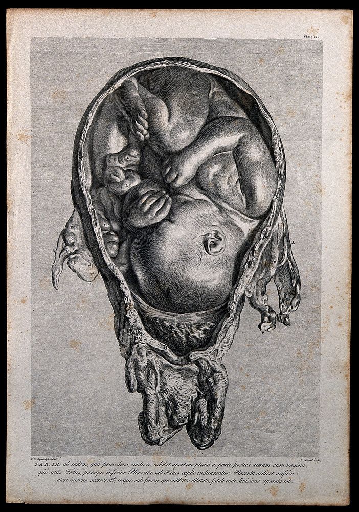 Dissection of a pregnant uterus, showing the foetus at nine months, with the head positioned towards the vagina and the…