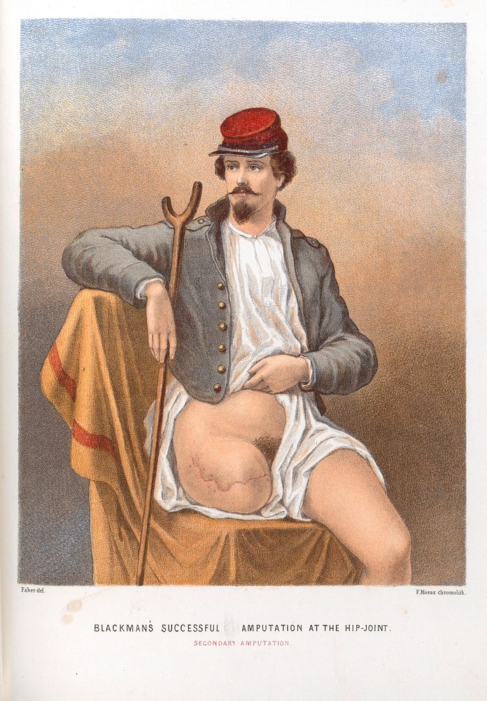 A report on amputations at the hip-joint in military surgery / by George A. Otis.