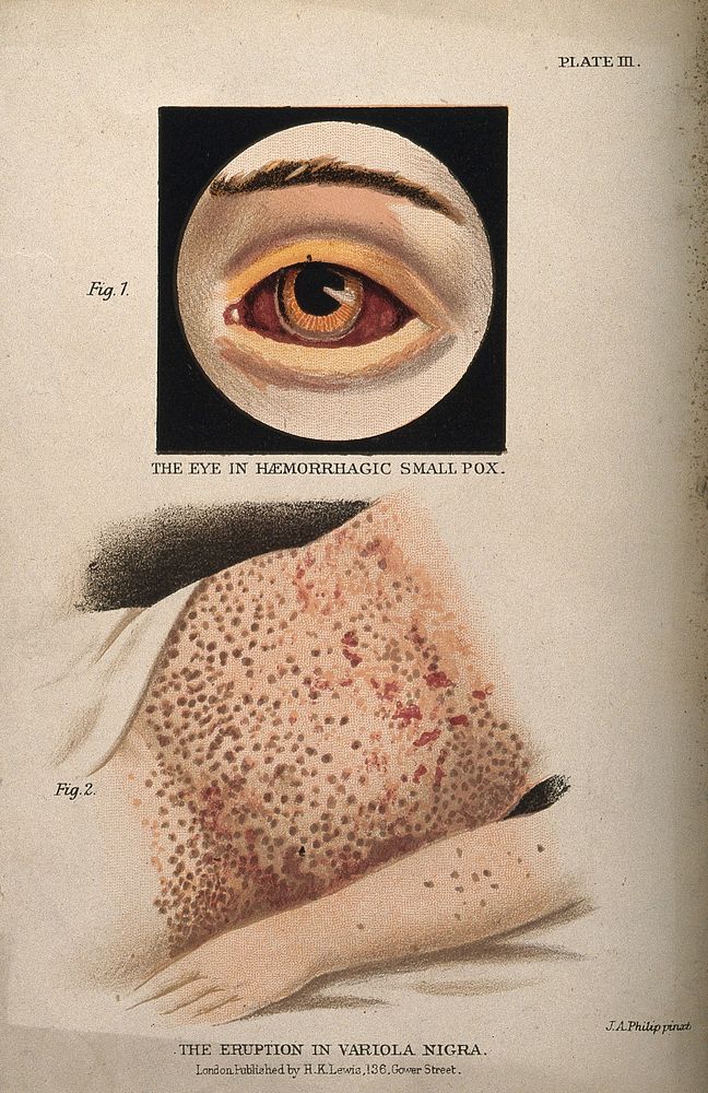 Above, a bloodshot eye showing symptoms of haemorrhagic smallpox, below, an eruption of variola nigra on the abdomen of a…