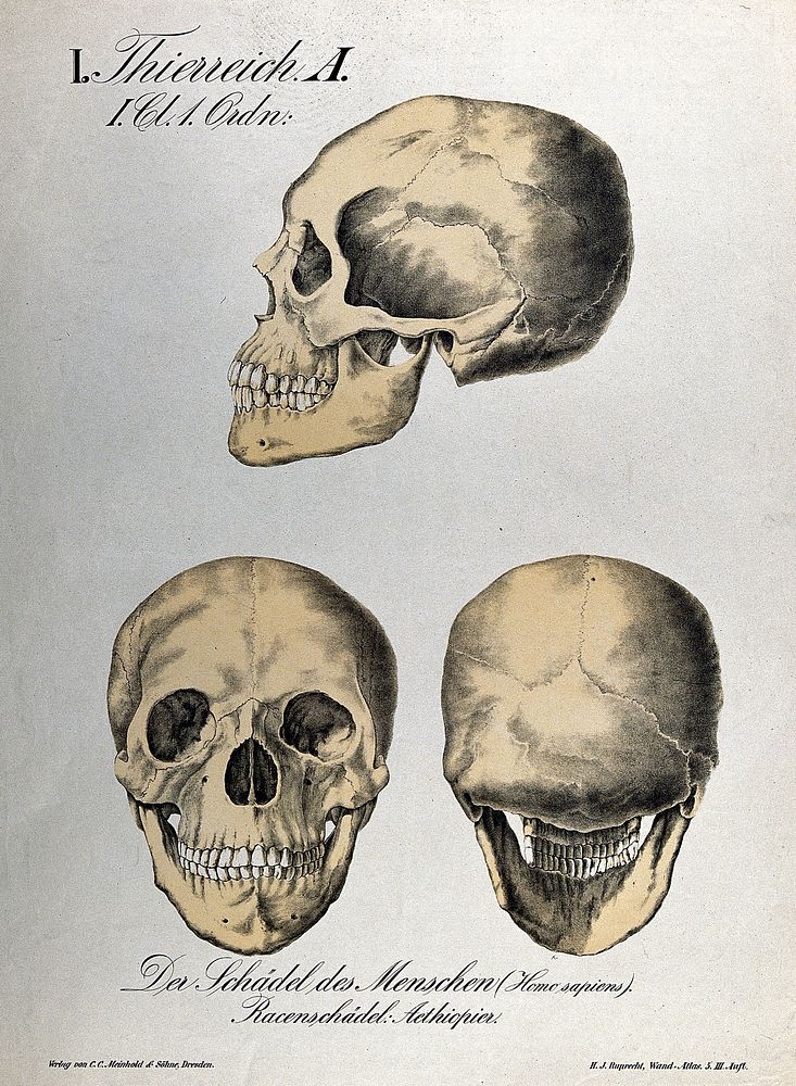 Skull of an Ethiopian person: three figures. Chromolithograph by H.J. Ruprecht, 1877.