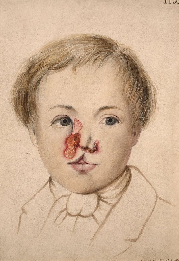 Tertiary, tubercular, ulcerating syphilide on the face of a child