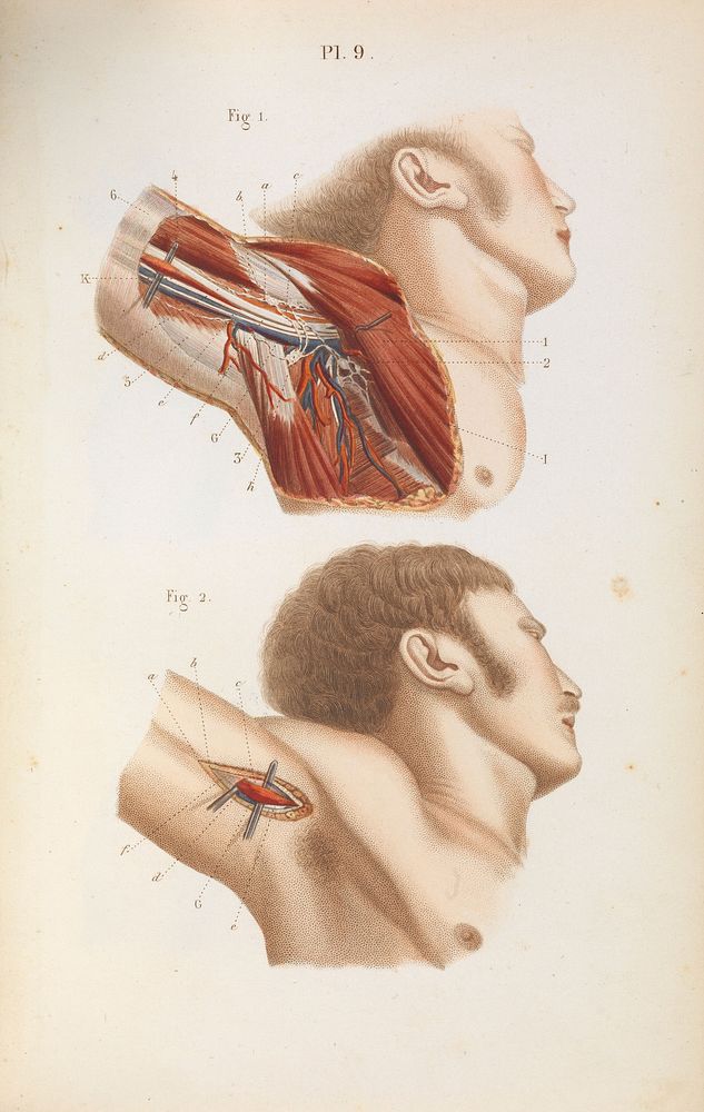 Précis iconographique de médecine opératoire et d'anatomie chirurgicale / [Claude Bernard].