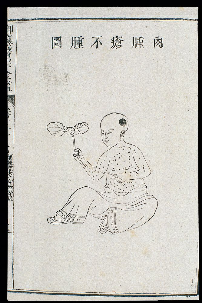 Chinese C18: Paed. pox - 'Swollen flesh, non-swollen lesions'