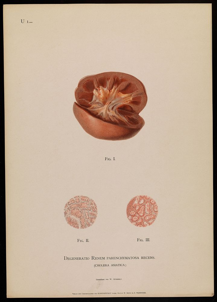 Illustrations of pathological anatomy : being a series of chromographed plates painted from nature immediately after death /…