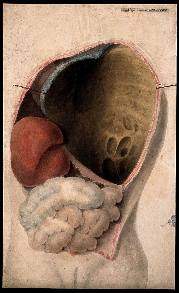 A dissected thorax with a collection of pus in the cavity. Watercolour, c. 1824.
