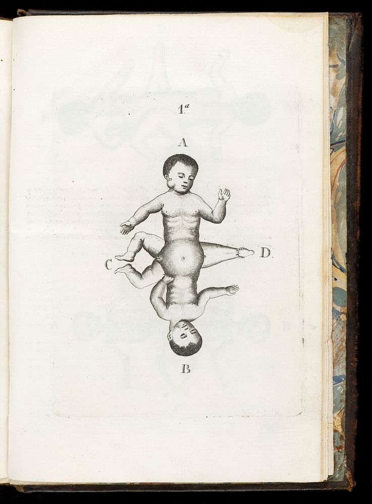 Plate showing two conjoined infants