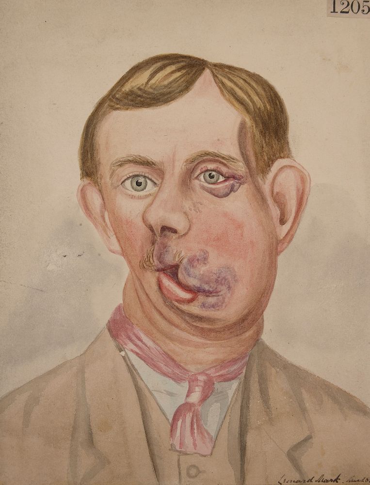 Man with a large congenital naevus on the right side of the face