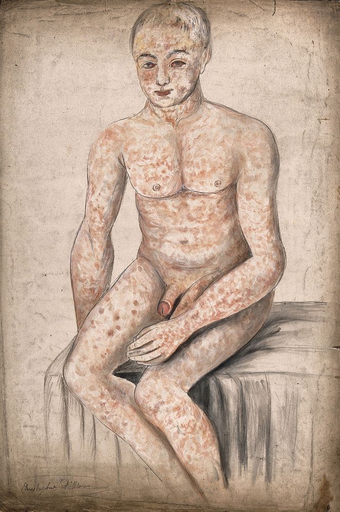 A seated man suffering from a mottled rash of sores, which covers his entire body and face. Watercolour by C. D'Alton, 1858.