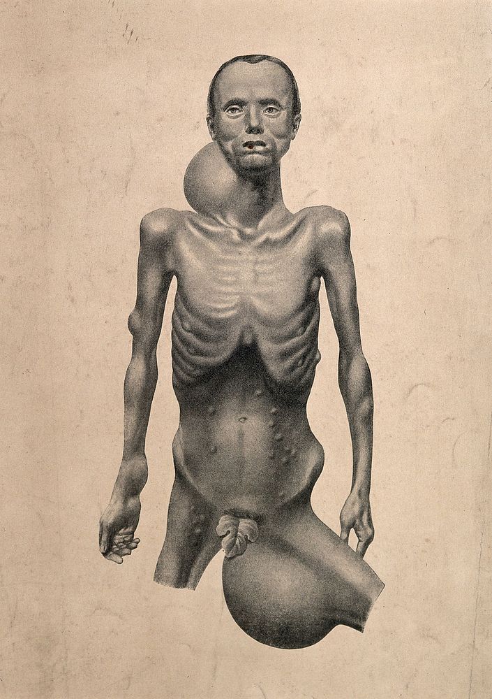 An emaciated naked man, displaying large swellings on his neck and groin, with smaller swellings visible on his chest, arms…