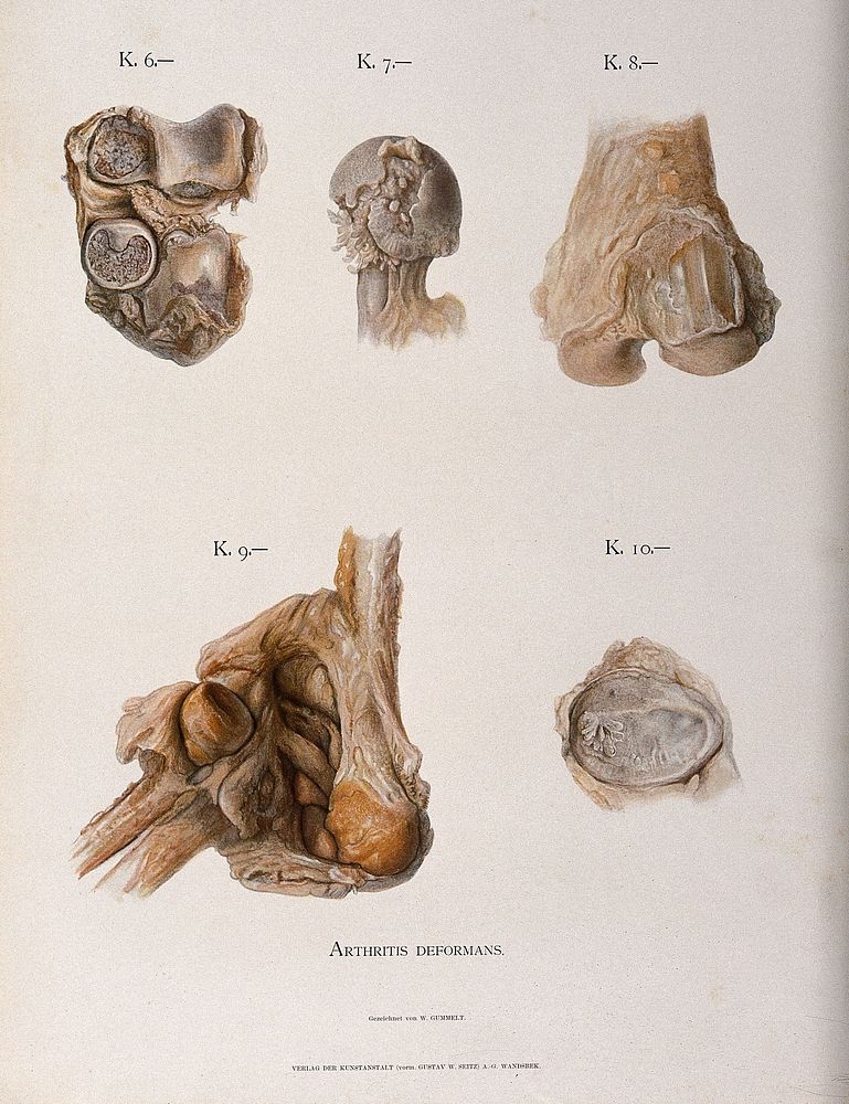 Bones and joints deformed by arthritis: five figures. Chromolithograph by W. Gummelt, ca. 1897.